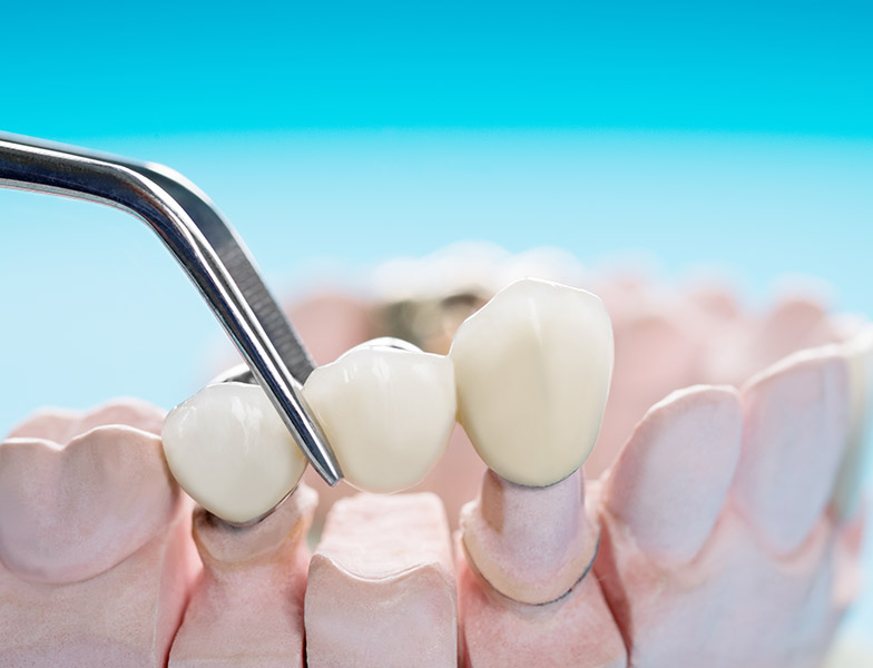 What Type of Dental Bridge Should I Get See Me Smile Dental Oxnard CA