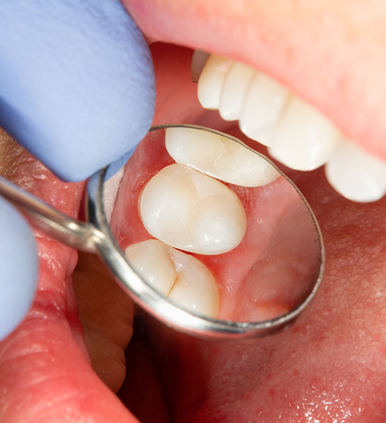 What Is the Process for Getting a Porcelain Inlay or Onlay See Me Smile Dental in Oxnard CA
