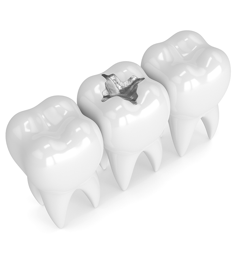 A Filling vs. a Porcelain Inlay See Me Smile Dental in Oxnard CA
