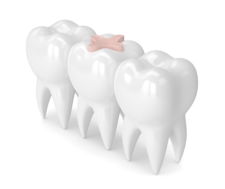 What Are the Most Common Restorative Dental Treatments at See Me Smile Dental Oxnard CA Image.