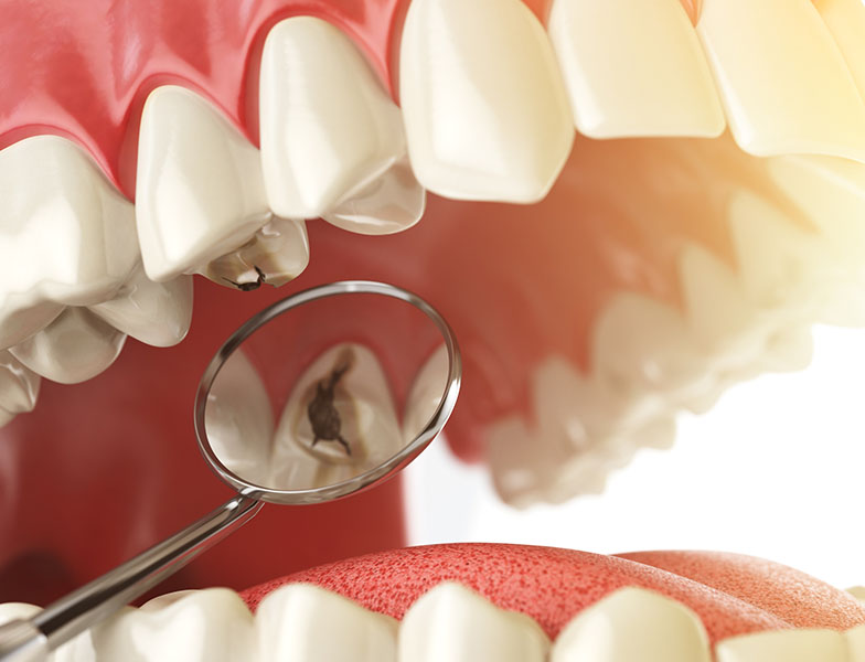 What Is Root Canal Therapy Used For See Me Smile Dental Oxnard CA Image.