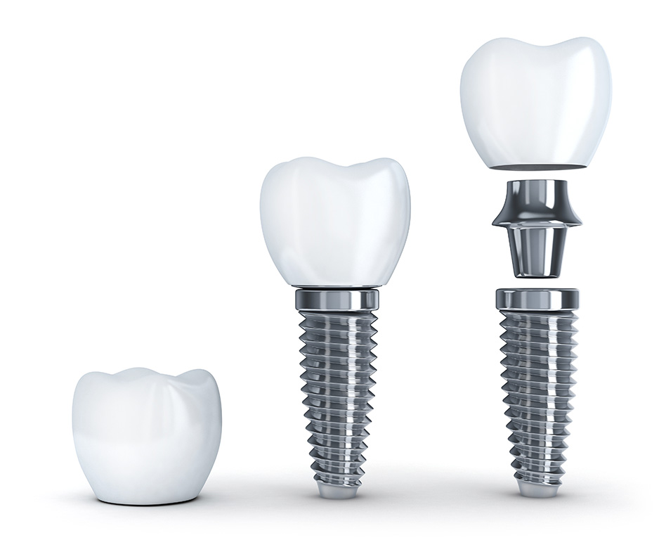What Is a Healing Abutment in Oxnard CA