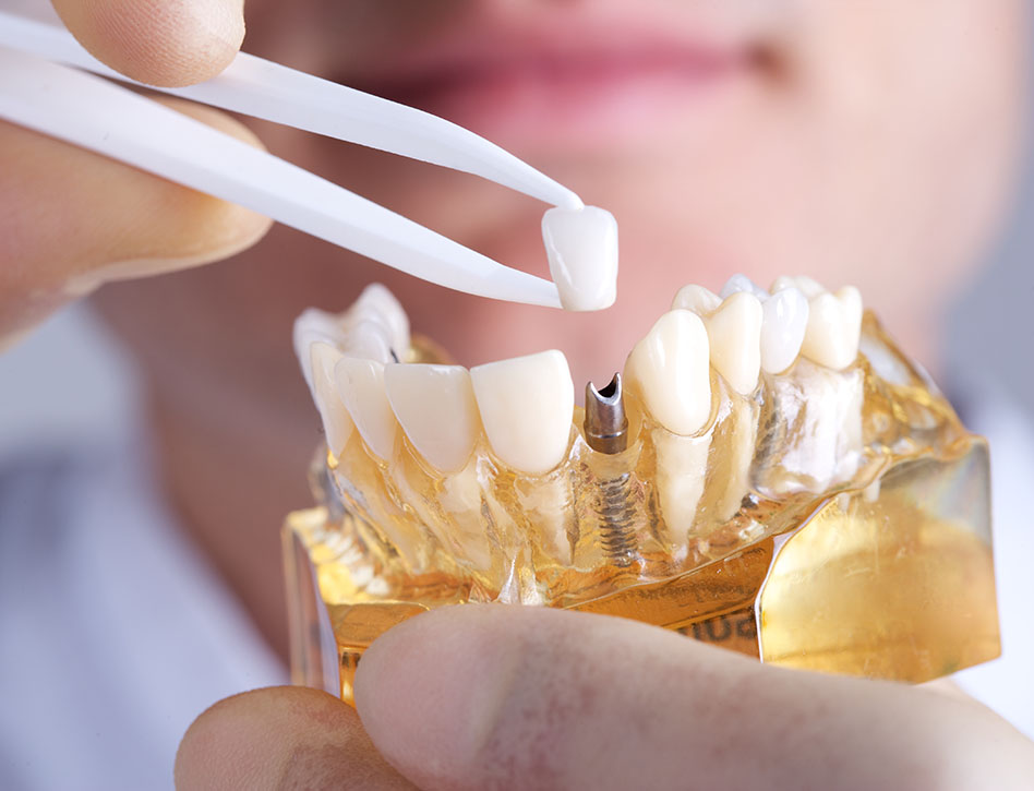 What Is the Process for Getting a Single Tooth Implant in Oxnard CA