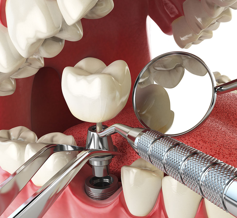 Am I a Good Candidate for Dental Implants in Oxnard CA